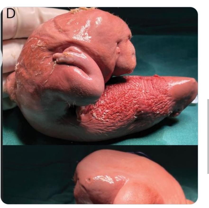 Feto en feto: médicos extraen “gemelo parásito” del cerebro de una niña